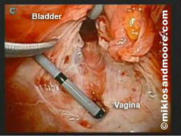 Picture 2--shows the separation of the stent and the fistula; the hole above is the bladder and the one below is the vagina