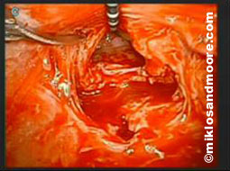 Fistula Repair picture 3