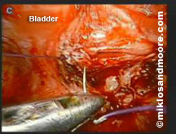 Picture 4—shows closing the edges of the bladder using a suture and needle