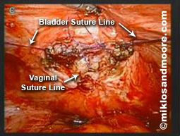 Picture 5---shows the placement of our 6th suture (out of 7) closing the bladder hole in an area of less than 1 inch (this is the first line of closure, we reinforced this closure with a second layer of sutures)