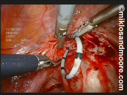 Fistula Repair Photo 1