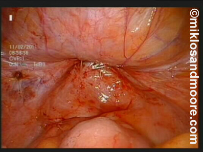 Fistula Repair Photo 1