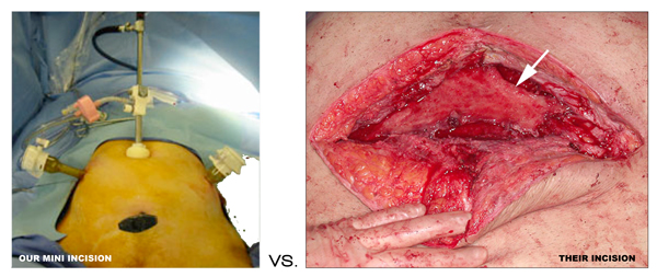 Most physicians around the world will attempt to repair the vesicovaginal fistulas (VVF) using a laparotomy. Dr Miklos & Moore know of no one else in the USA who has there experience performing VVF repair via laparoscopically. See their incisions -laparoscopic- (small incision) versus others -laparotomy- (big incision). Which would you rather have?