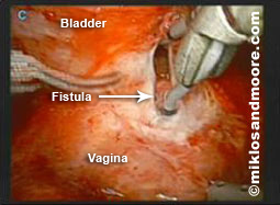 Picture 1--shows opening the fistula tract with the bladder above and the vagina below